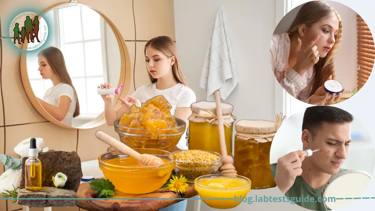 What are the Best Home Remedies for Acne