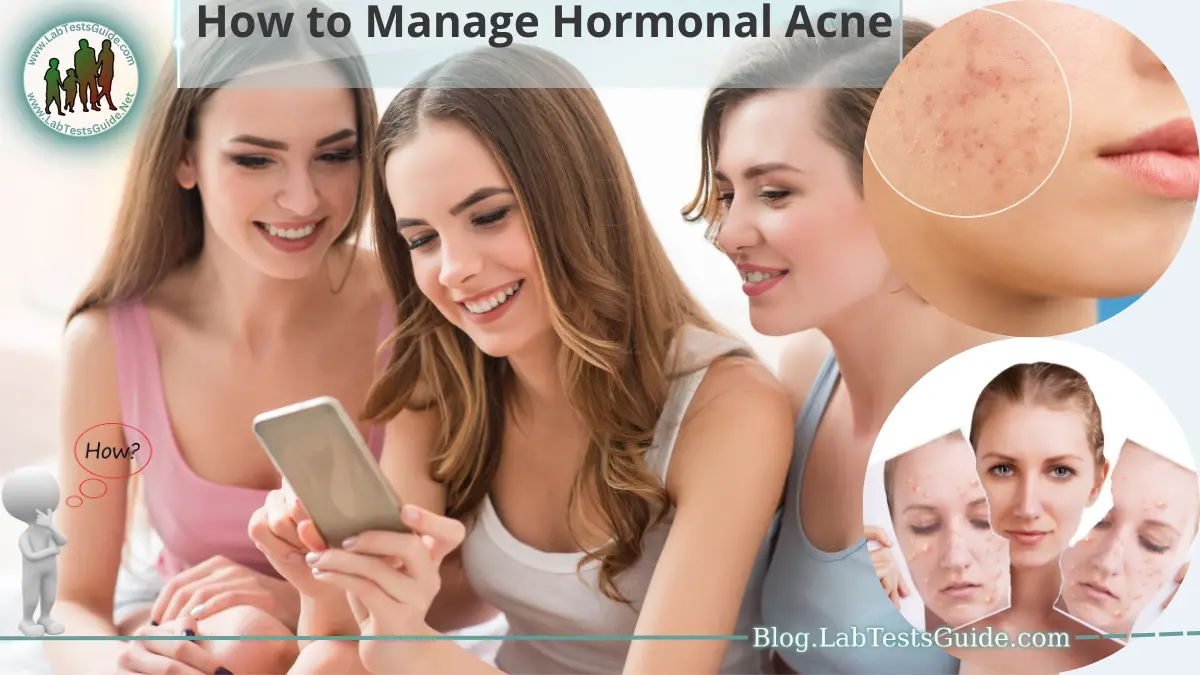 How to Manage Hormonal Acne