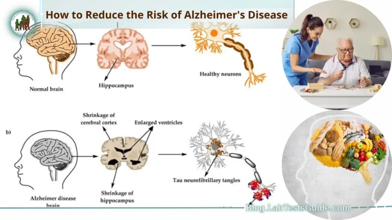 Alzheimer's disease is a progressive and devastating neurodegenerative condition that affects millions of people worldwide. As the aging population grows, understanding and implementing strategies to reduce the risk of Alzheimer's becomes increasingly crucial.